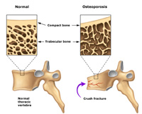 osteoporosi